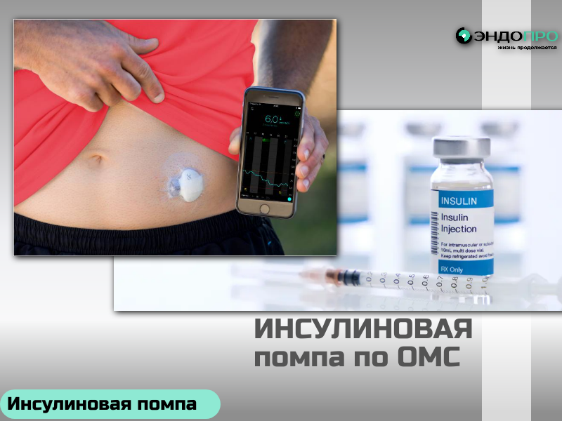 Особенности инсулиновой помпы Medtronic MiniMed 720G? Для граждан РФ по ОМС Инсулиновая помпа Medtronic MiniMed 720G — это компактное устройство (96 × 53,6 × 24,4 мм, вес 106 г), которое имитирует работу здоровой поджелудочной железы: непрерывно подаёт ультракороткий инсулин микродозами в базальном режиме и позволяет вводить болюсы для компенсации пищи. Инфузионный набор меняется раз в три дня, что заменяет множество ежедневных инъекций. Точность и гибкость дозирования. Шаг подачи — всего 0,025 Ед, что обеспечивает высокую точность, особенно важную для детей и людей с высокой чувствительностью к инсулину. Можно настроить до 48 базальных скоростей в сутки и сохранить до 8 разных профилей — например, отдельно для будней, выходных или спортивных дней. Временная базальная скорость