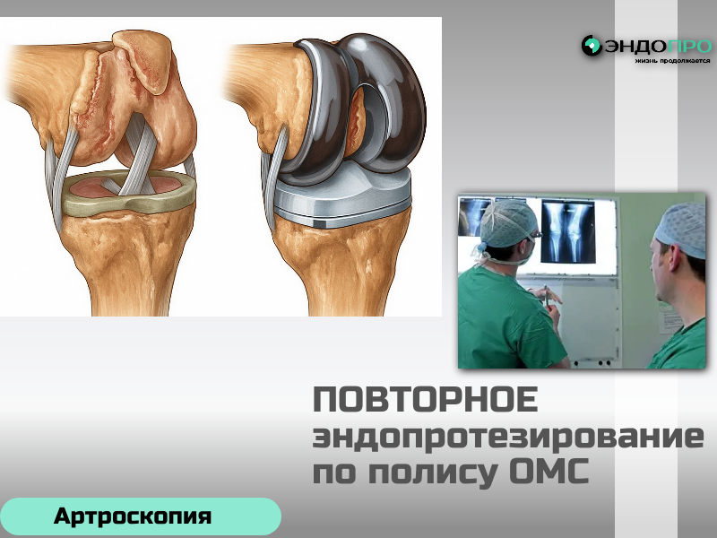 Через какой время нужно делать повторное эндопротезирование? доступно по ОМС для граждан РФ Нет жёсткого графика: повторную операцию (ревизионное эндопротезирование) делают не по расписанию, а когда в этом появляется реальная необходимость. В среднем современные протезы рассчитаны на 15–25 лет службы, но у кого-то имплант прослужит дольше, а кому-то замена может понадобиться раньше. Поводом стать сигналом к действию могут стать такие ситуации: износ компонентов протеза, его расшатывание и потеря стабильности, развитие инфекции в области операции, которая не поддаётся консервативному лечению, перипротезный перелом кости, сильная боль или деформация сустава после первичной операции, а в редких случаях — аллергия на материалы импланта. Иногда причиной становится остеолизис — реакция организма, при которой кость вокруг протеза постепенно разрушается, что ведёт к ослаблению фиксации.