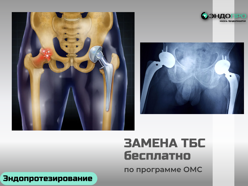 Замена тазобедренного сустава по ОМС — бесплатная операция при наличии показаний Государство покрывает вмешательство, протез, стационар, медикаменты и питание. Для оформления нужно обратиться к ортопеду/травматологу — врач проведёт осмотр, назначит обследования и при необходимости выдаст направление. Решение принимает врачебная комиссия на основании снимков, анализов и состояния пациента. Срок ожидания — от нескольких недель до года (зависит от региона и загруженности клиники); в экстренных случаях (например, при переломе шейки бедра) операцию делают вне очереди. После вмешательства пациенту предоставляют
