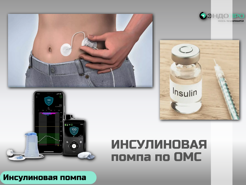 Как работает инсулиновая помпа ночью? БЕСПЛАТНО (ОТ 18 ЛЕТ) Ночью помпа работает в базальном режиме — непрерывно подаёт микродозы инсулина, поддерживая сахар на стабильном уровне, пока вы спите. Скорость подачи можно настроить по часам: снизить вскоре после ужина, когда риск гипогликемии выше, и увеличить к утру, когда из-за «феномена зари» глюкоза начинает расти.