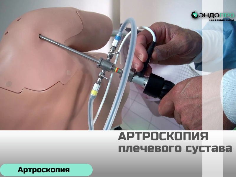 Реабилитация после артроскопии плечевого сустава (в том числе по ОМС) Сроки определяет лечащий врач. В среднем восстановление длится 3–6 месяцев. Основные этапы: 3–6 недель — иммобилизация (рука в косынке или ортезе), разрешены движения в пальцах, кисти и локте. 6–12 недель — постепенная разработка сустава и щадящие упражнения под контролем специалиста. С 3‑го месяца — укрепление мышц, возврат к бытовым нагрузкам, позже (по разрешению врача) — к спорту и тяжёлой работе. На длительность реабилитации влияют объём операции (например, при шве вращательной манжеты сроки больше), возраст, физподготовка и сопутствующие заболевания. Дистанционную консультацию можно пройти (Бесплатно), не приезжая в Центр,