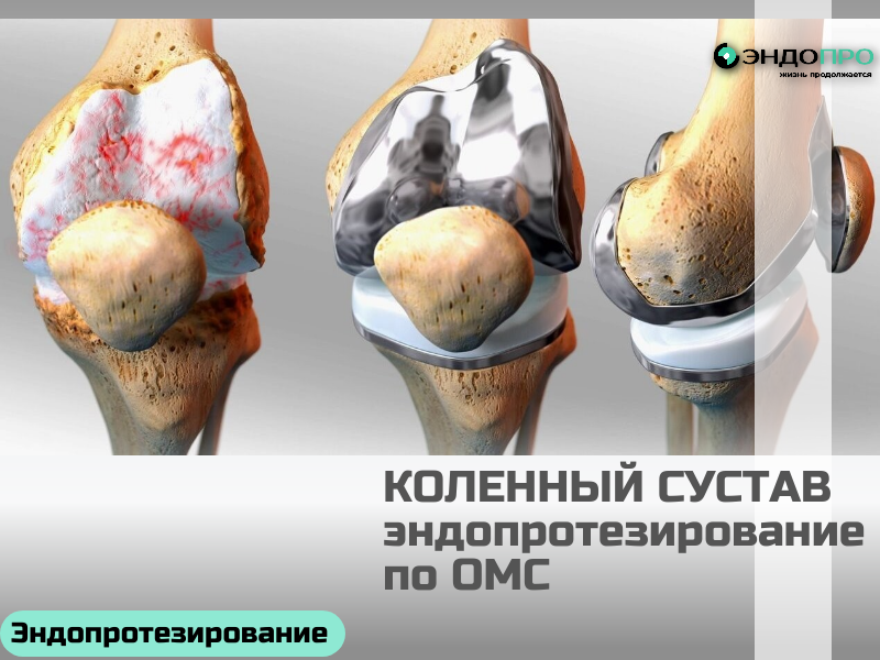 Замена коленного сустава в России (эндопротезирование) По ОМС для граждан РФ Эффективный способ вернуть подвижность и избавиться от сильной боли. Операцию проводят при тяжёлых поражениях сустава, когда консервативное лечение не помогает, — решение принимает врач после диагностики (МРТ, рентген, анализы и др.). В России эндопротезирование доступно как на платной основе, так и по ОМС: в рамках программы государство покрывает стоимость операции, протеза и стационарного лечения. Направление выдаёт травматолог‑ортопед после подтверждения показаний; сроки ожидания зависят от региона и загруженности медучреждения. Реабилитация занимает в среднем 3–6 месяцев и включает ЛФК, физиотерапию и поэтапное увеличение нагрузки — план подбирает лечащий врач индивидуально. Современные эндопротезы служат 15–20 лет и позволяют существенно улучшить качество жизни пациента.