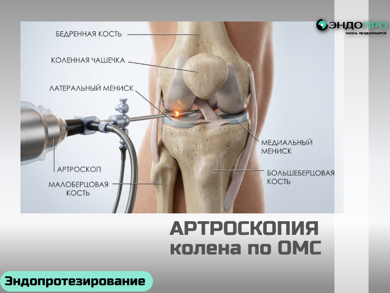 Артроскопия коленного сустава по ОМС доступна гражданам России от 18 лет при наличии показаний.
Ход операции начинается с обезболивания — его тип подбирает врач индивидуально:

местная анестезия — для коротких диагностических манипуляций;
спинальная — пациент в сознании, но не чувствует боли ниже пояса (наиболее частый вариант);
общий наркоз — при длительных вмешательствах или по показаниям/предпочтениям пациента.
Перед процедурой анестезиолог изучает анамнез, сопутствующие заболевания и объём операции, чтобы выбрать максимально безопасный метод обезболивания. Сама артроскопия проводится через небольшие проколы: в сустав вводят камеру и инструменты, врач оценивает состояние тканей и при необходимости выполняет лечебные манипуляции.