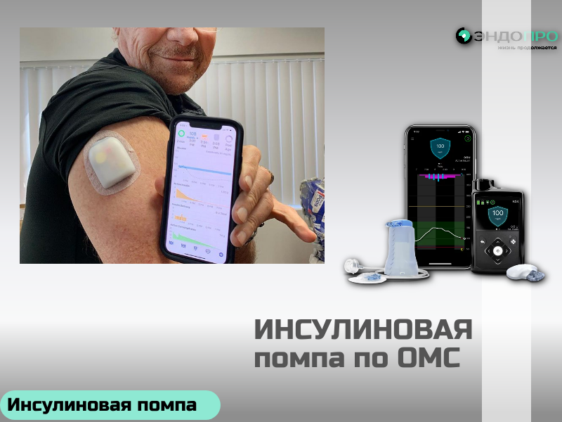 Помпа инсулиновая Medtronic MiniMed 720G? Для граждан РФ по ОМС Инсулиновая помпа Medtronic MiniMed 720G — современное устройство для непрерывного введения инсулина, которое помогает поддерживать стабильный уровень глюкозы и снижает необходимость в многократных инъекциях. Одна из ключевых особенностей модели — интеграция с системой непрерывного мониторинга глюкозы (в паре с сенсором Guardian Sensor 3 и трансмиттером Guardian Link 3). Помпа анализирует тренды уровня сахара и заранее (примерно за 30 минут) предупреждает о риске гипо‑ или гипергликемии. Если есть угроза низкого сахара, функция SmartGuard автоматически приостанавливает подачу инсулина — это помогает избежать тяжёлой гипогликемии, в том числе ночью. Устройство отличается высокой точностью дозирования: шаг подачи составляет всего 0,025 Ед, что особенно важно для пациентов с высокой чувствительностью к инсулину. Можно гибко настраивать терапию: задавать до 48 базальных скоростей в сутки и сохранять до 8 разных профилей (например, для будней, выходных, тренировок). Временная базальная скорость регулируется в диапазоне 0–200 % от базового значения на срок от 30 минут до 24 часов — это
