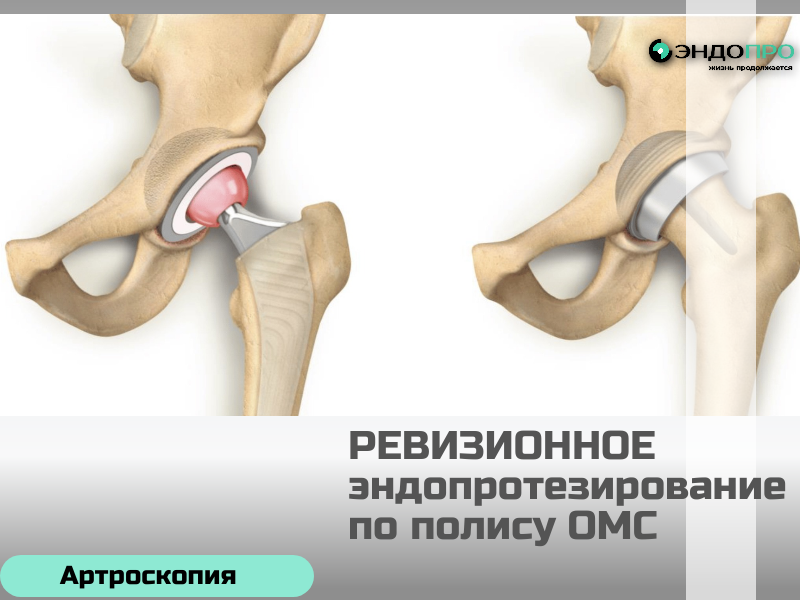 Ревизионное эндопротезирование — это повторная операция по замене ранее установленного эндопротеза сустава (доступно по ОМС для граждан РФ) Её проводят, если протез износился, расшатался, сместился либо возникли осложнения (в том числе инфекция) — решение принимает врач после обследования. В отличие от первичной замены, ревизия технически сложнее: нередко нужно восполнять дефицит костной ткани, учитывать рубцовые изменения и подбирать специальные протезы. Перед операцией делают рентген, при необходимости — КТ или МРТ, сдают анализы, чтобы точно определить причину проблем с прежним имплантом. Операция проходит под спинальной или общей анестезией: хирург удаляет старые компоненты, при необходимости выполняет костную пластику, затем устанавливает новый протез. Реабилитация длительная и строго индивидуальная: включает ЛФК, физиотерапию, поэтапное наращивание нагрузки; сроки и режим определяет