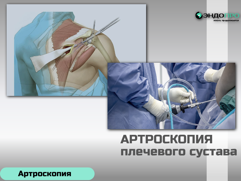 Реабилитация после артроскопии плечевого сустава поэтапное восстановление (в том числе в рамках ОМС) Этапы восстановления 3–6 недель: этап иммобилизации. Плечевой сустав фиксируют с помощью косынки либо ортеза, чтобы создать оптимальные условия для заживления тканей. При этом разрешены движения в пальцах, кисти и локтевом суставе — это помогает сохранить подвижность дистальных отделов и снизить риск отёка и тугоподвижности. 6–12 недель: постепенная разработка сустава. На этом этапе под контролем специалиста начинают выполнять щадящие упражнения для восстановления амплитуды движений. Важно не форсировать нагрузку: преждевременные активные движения могут нарушить процессы регенерации, особенно если во время операции выполнялся шов вращательной манжеты. С 3‑го месяца: укрепление мышечного корсета и поэтапный возврат к нагрузкам. Акцент смещается на силовые и стабилизирующие упражнения, направленные на восстановление функции плечевого пояса. Сначала возвращаются к бытовым нагрузкам, а позже, только по разрешению врача, — к спортивным тренировкам и тяжёлой физической работе.