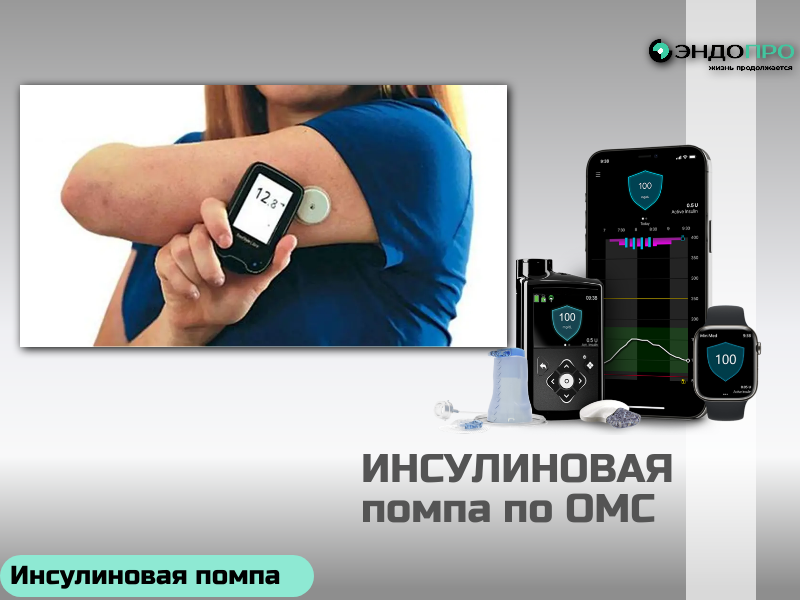 Инсулиновая помпа Medtronic MiniMed 720G: точность и защита от гипогликемии (доступна по ОМС бесплатно с 18 лет) MiniMed 720G — система непрерывной инсулинотерапии, которая помогает держать уровень глюкозы под контролем и снижает риск гипогликемий. Работает с ультракороткими аналогами инсулина: подача идёт через инфузионный набор — его меняют раз в 3 дня, поэтому многократные уколы не нужны. Ключевые особенности: Высокая точность дозирования. Шаг подачи — всего 0,025 Ед: это важно для пациентов с повышенной чувствительностью к инсулину. Гибкая настройка базального профиля. Можно задать до 48 временных интервалов в сутки и сохранить до 8 разных профилей, а временную базальную скорость — установить в диапазоне 0–200 % на срок от 30 минут до 24 часов. Технология SmartGuard. В связке с сенсором Guardian Sensor 3 и трансмиттером Guardian Link 3 система отслеживает глюкозу и прогнозирует тренды. Если предвидится падение сахара, подача инсулина автоматически приостанавливается — это особенно помогает ночью. Практичность в использовании. Работает от обычной батарейки AA, хранит данные за 90 дней, синхронизируется с приложением MiniMed Mobile и платформой CareLink