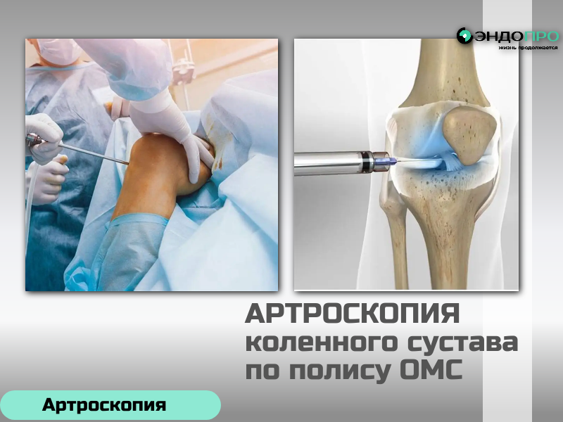 Артроскопия коленного сустава по ОМС: доступно и безопасно Граждане РФ старше 18 лет могут пройти артроскопию коленного сустава бесплатно — при наличии медицинских показаний и в рамках программы ОМС. Перед операцией анестезиолог анализирует анамнез, сопутствующие заболевания и объём вмешательства, чтобы подобрать максимально безопасный метод обезболивания. Варианты: Местная анестезия — подходит для коротких диагностических процедур. Спинальная анестезия — наиболее распространённый вариант: пациент остаётся в сознании, но не ощущает боли ниже пояса. Общий наркоз — применяется при длительных операциях либо по медицинским показаниям или пожеланиям пациента. Сама процедура малотравматична: врач делает небольшие проколы, вводит в сустав артроскоп с камерой и специальные инструменты. Так он визуально оценивает состояние тканей и при необходимости сразу выполняет лечебные манипуляции.