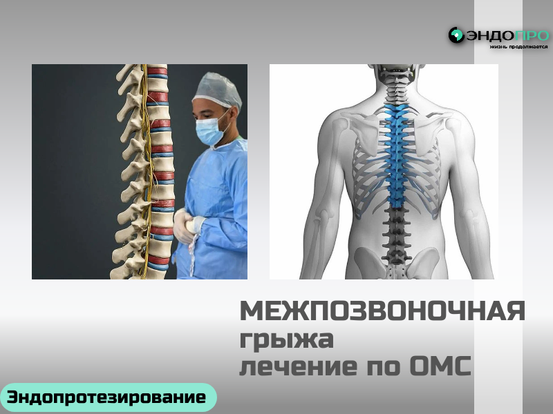 Межпозвоночная грыжа: симптомы и лечение по ОМС для граждан РФ Проявления грыжи зависят от её локализации. При грыже в поясничном отделе типична боль в спине с иррадиацией в ногу (ишиас), онемение, покалывание или слабость в конечности; дискомфорт нарастает при кашле, наклонах и долгом сидении. Если поражён шейный отдел, возможны головные боли, головокружение, шум в ушах, онемение рук. Экстренная помощь нужна при нарушениях функции тазовых органов — это опасный признак. Лечение по ОМС строится поэтапно: Консервативная терапия. В остром периоде применяют НПВП и миорелаксанты, при выраженной боли — паравертебральные блокады. Восстановление. После уменьшения боли основу лечения составляют ЛФК для укрепления мышечного корсета, физиотерапия и дозированные нагрузки. Хирургия. Операцию (микродискэктомию или эндоскопическое удаление грыжи) рассматривают, если на фоне терапии боль сохраняется несколько месяцев, нарастает неврологический дефицит либо есть «красные флаги»: прогрессирующая слабость, потеря